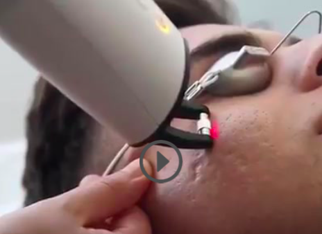 Cicatrice d'acné - Dermo Laser Strasbourg