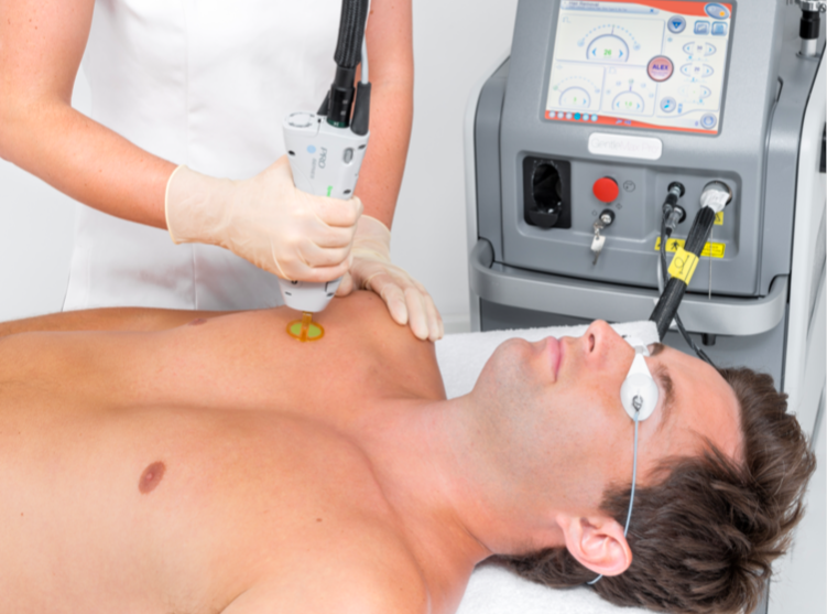 Traitement des cicatrices par laser