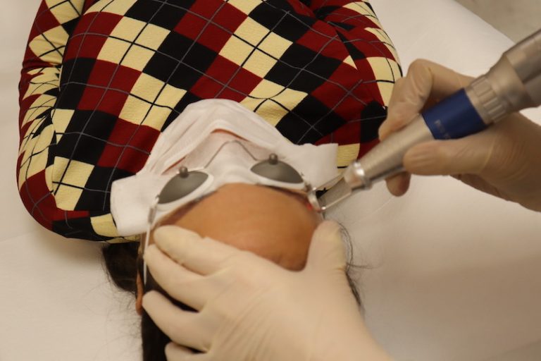 Détatouage sourcils - Dermo Laser Strasbourg