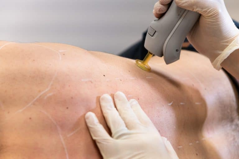L'épilation laser pour les hommes - Dermo Laser Strasbourg