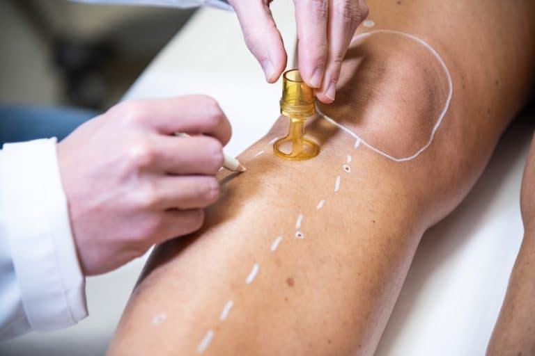 Epilation définitive - choisir entre laser ou lumière pulsée-dermo laser Strasbourg