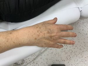 Dermo Laser Strasbourg - Comment retirer ses tâches brunes sur la peau grâce au laser ?