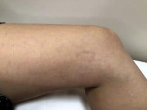 Comment faire disparaitre ses varicosités - Dermo Laser Strasbourg