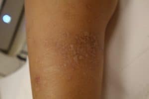 Cicatrice laser - Dermo Laser Strasbourg