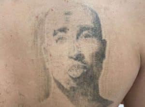 Comment le type de tatouage joue-t-il sur le nombre de séances de détatouage - Dermo Laser Strasbourg