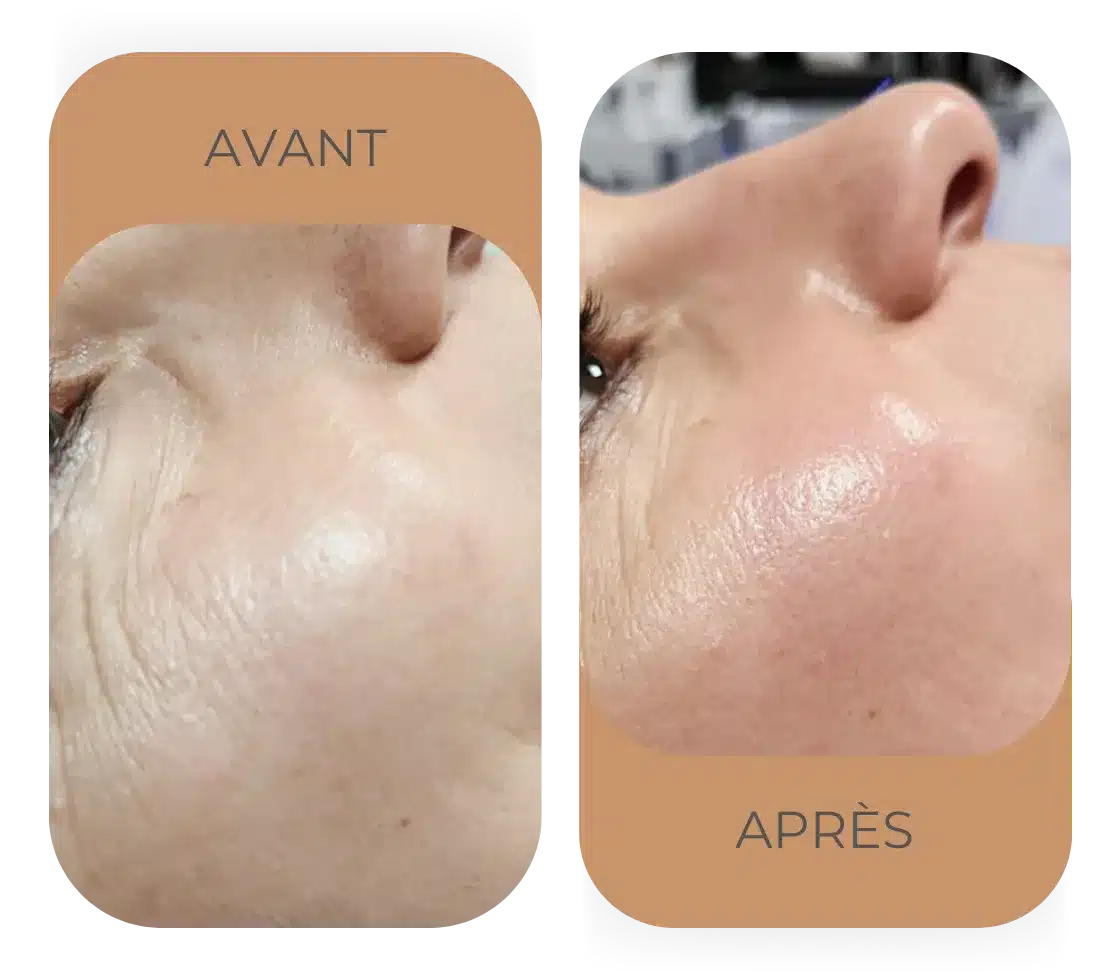 Résultat HydraFacial luminosité teint
