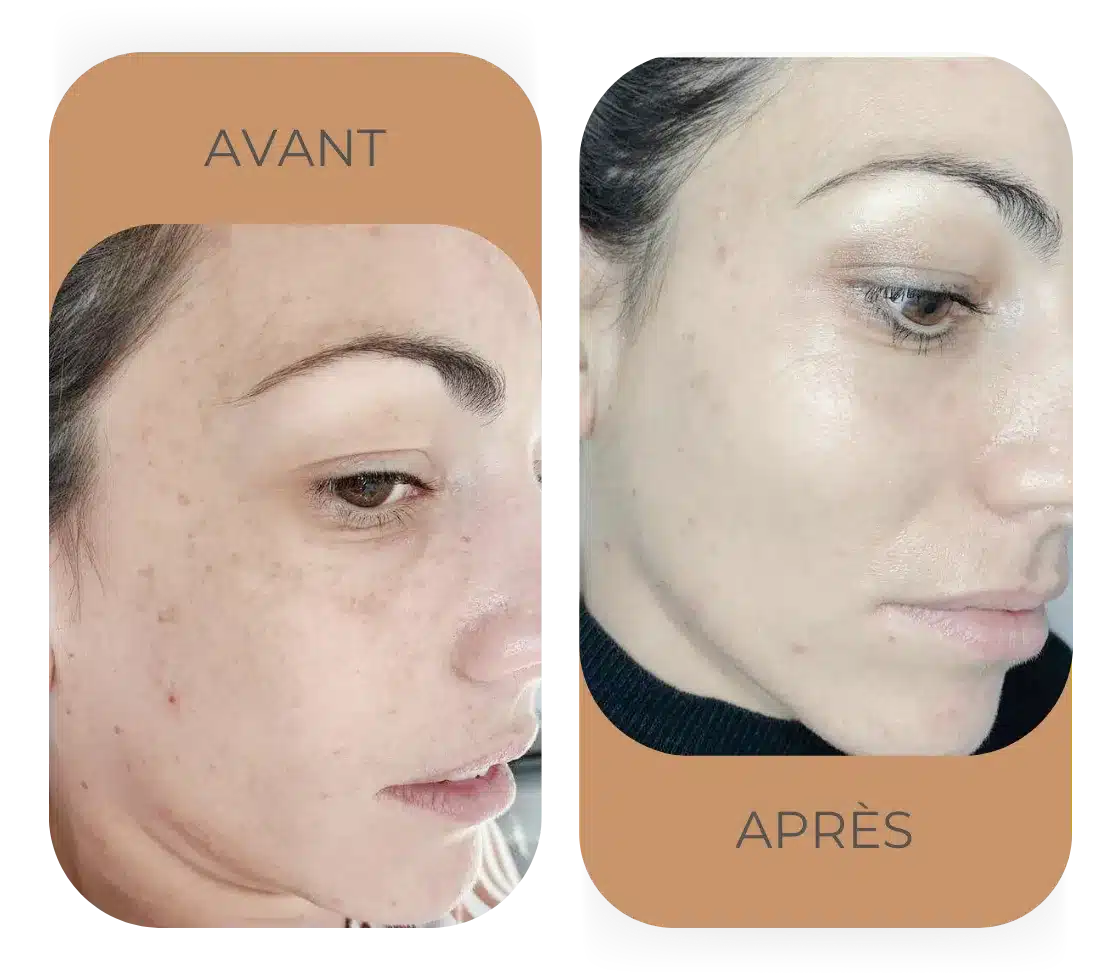 Résultat HydraFacial pores resserrés