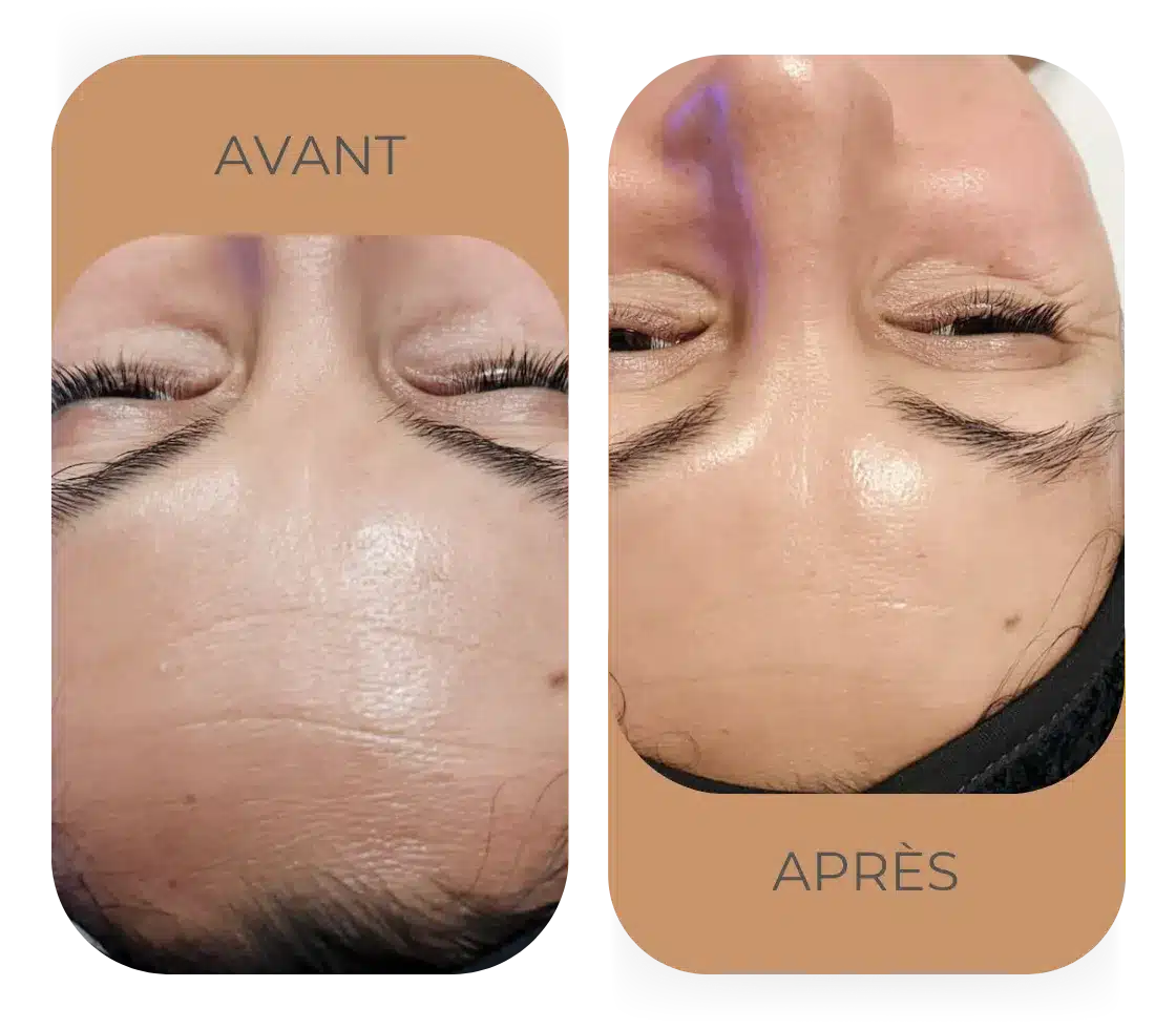 Résultat HydraFacial avant après